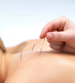 acupuncture